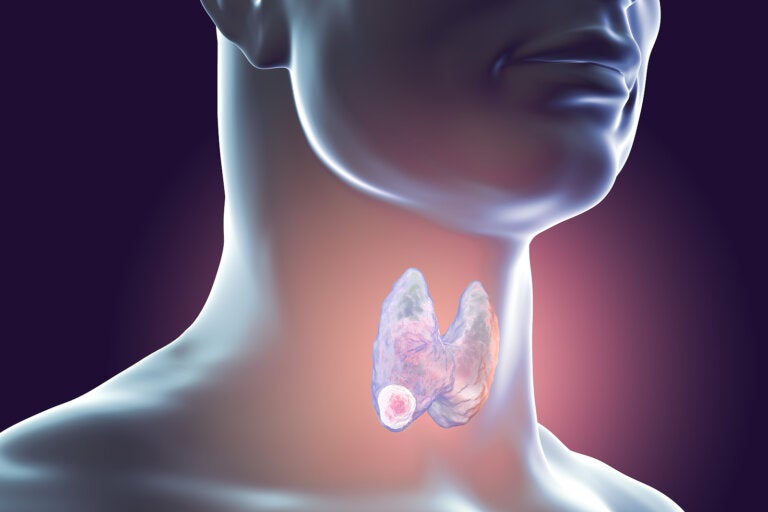 Cáncer de tiroides | Cuáles son los síntomas, quiénes presentan mayor riesgo y cómo prevenirlo